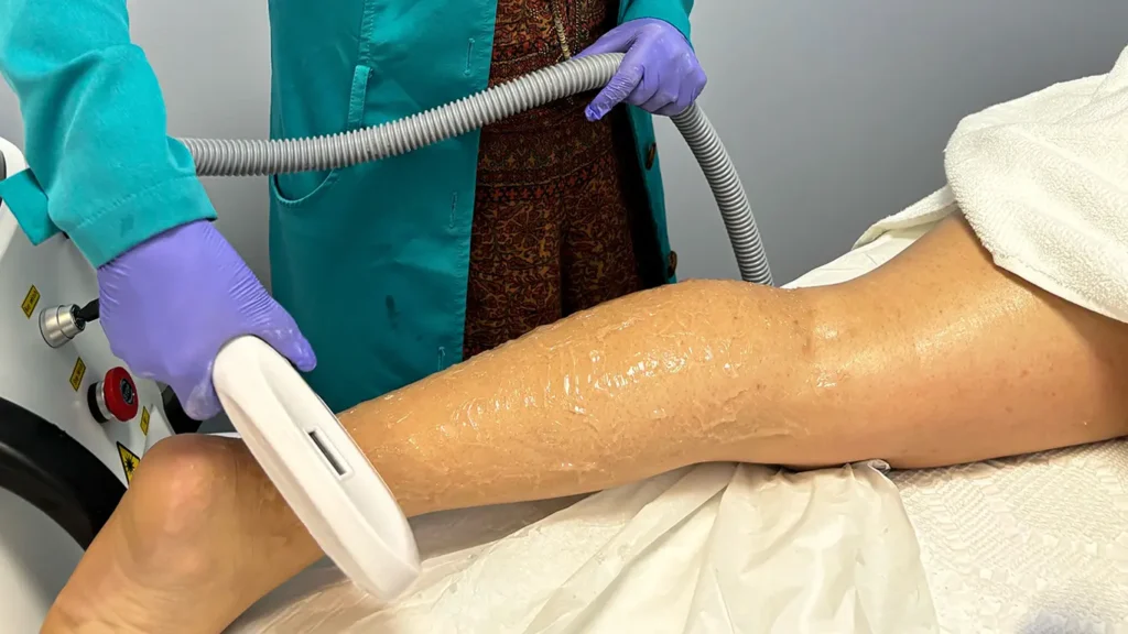 Laser IPL